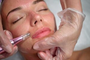 microneedling rhode island