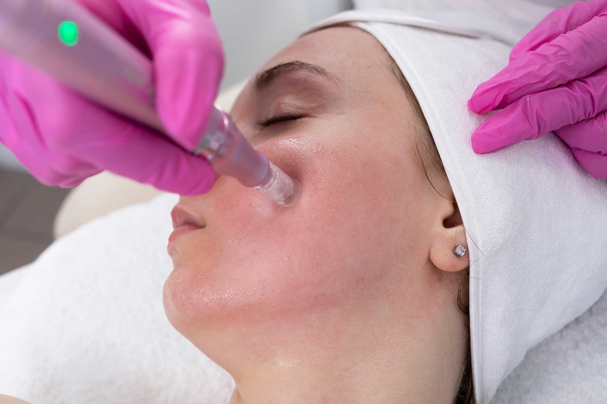 microneedling providence rhode island
