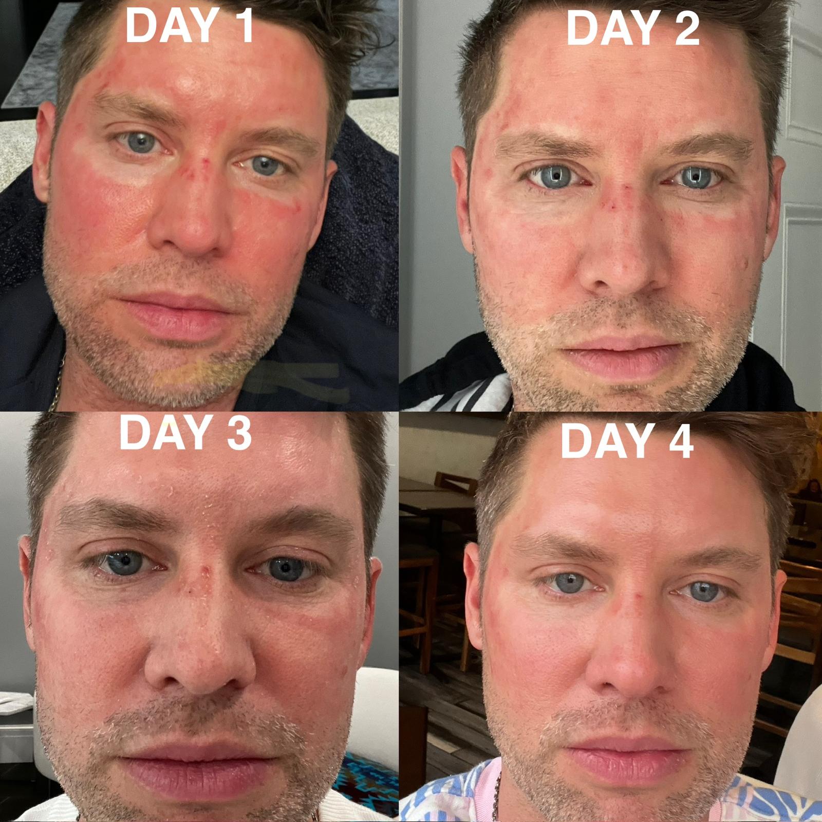 microneedling recovery rhode island provider